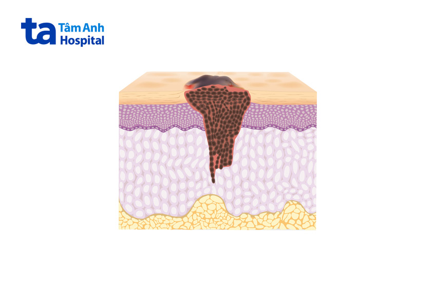 ung thư da tế bào gai, tế bào đáy hoặc bệnh hắc tố da có thể làm da nổi đốm nâu không ngứa