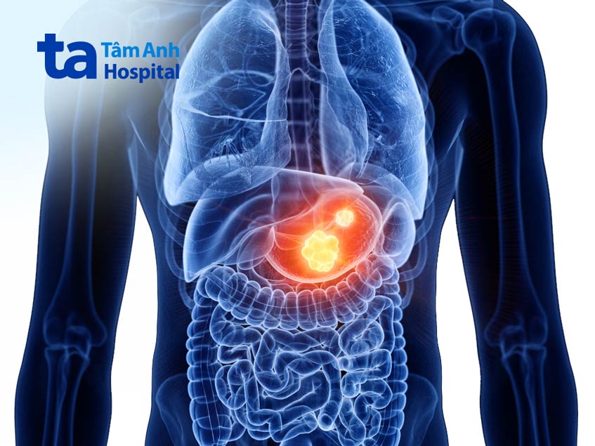 ung thư di căn các cơ quan khác