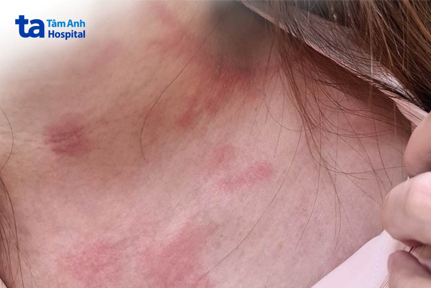 vết bỏng da do nọc độc kiến ba khoang