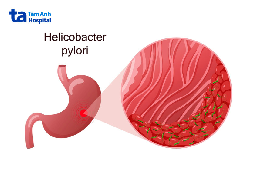 vi khuẩn helicobacter pylori