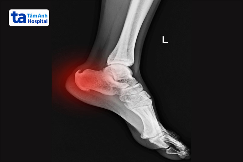 Viêm gót chân là gì? Viêm gót chân là gì?