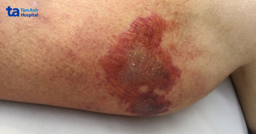 viêm mô mỡ dưới da là khối u dưới da