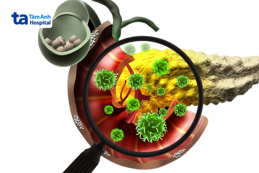 viêm tụy cấp nguy hiểm không