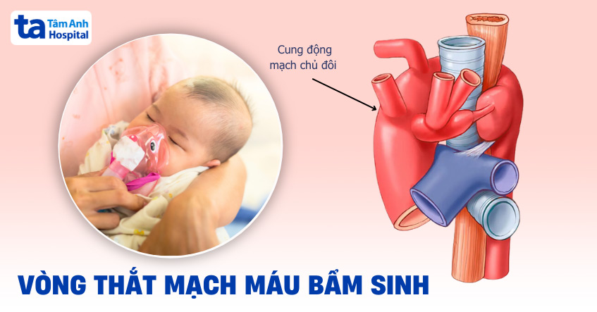 Vòng thắt mạch máu: Nguyên nhân, triệu chứng, chẩn đoán và điều trị