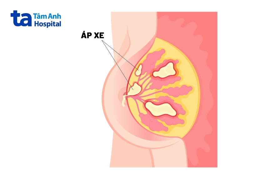 vú nổi cục cứng không đau