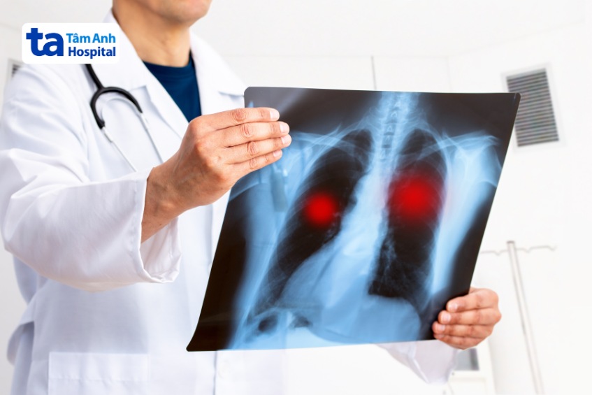Xét nghiệm hình ảnh chẩn đoán viêm phổi không điển hình