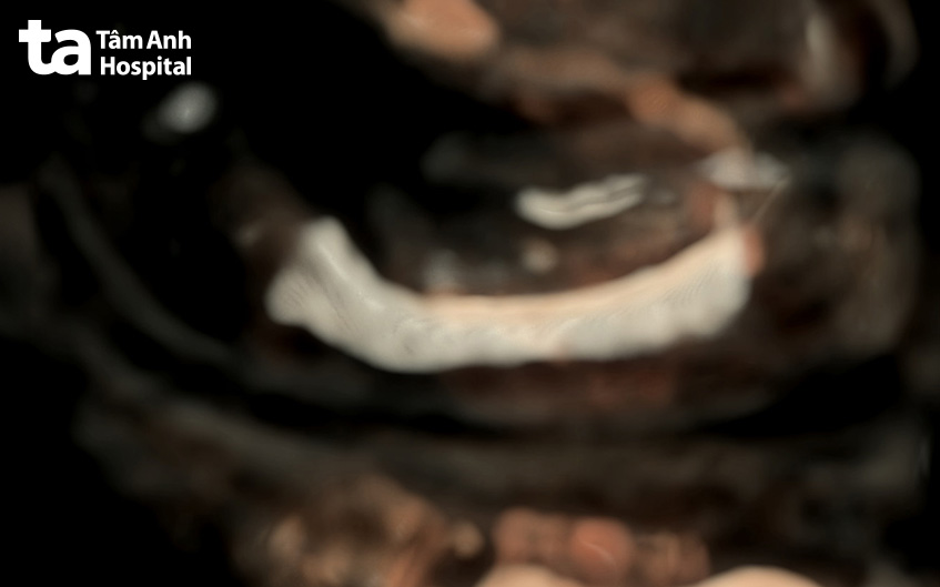 xương đùi thai nhi ngắn, cong khi siêu âm 20 tuần