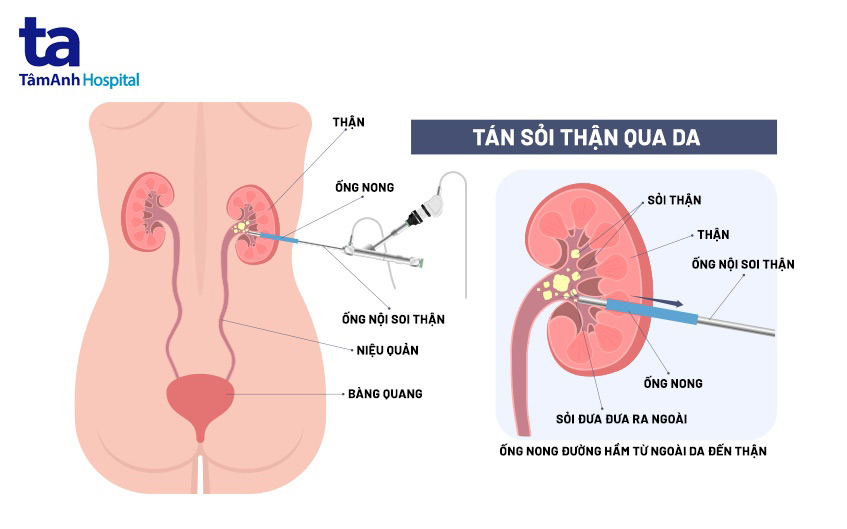 ảnh minh họa phương pháp nội soi tán sỏi qua da