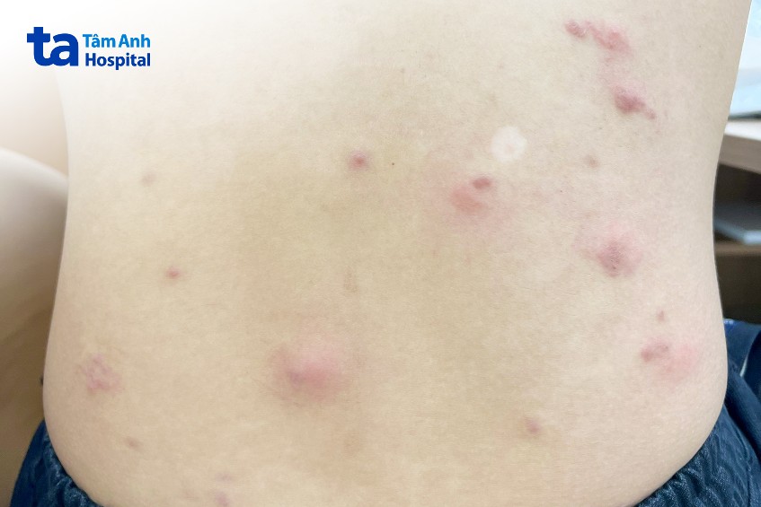 ấu trùng giun móc di chuyển trên lưng