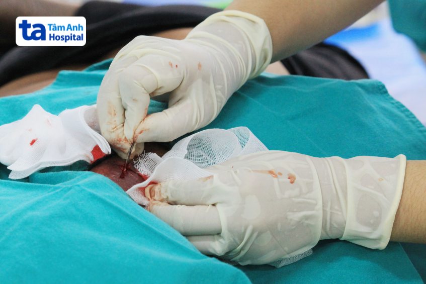 bác sĩ có thể chỉ định điều trị bằng phương pháp rạch dẫn lưu nhọt