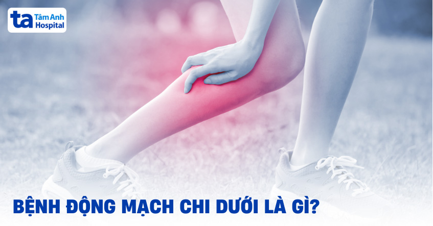 Bệnh động mạch chi dưới: Nguyên nhân, triệu chứng, chẩn đoán, điều trị
