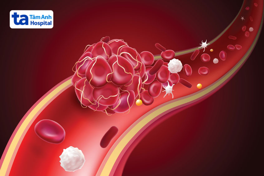 Bệnh nhân có thể bị huyết khối sau khi đặt máy tạo nhịp tim tạm thời