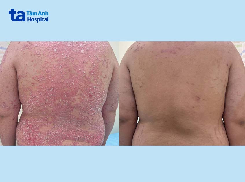bệnh nhân trước và sau khi điều trị vảy nến