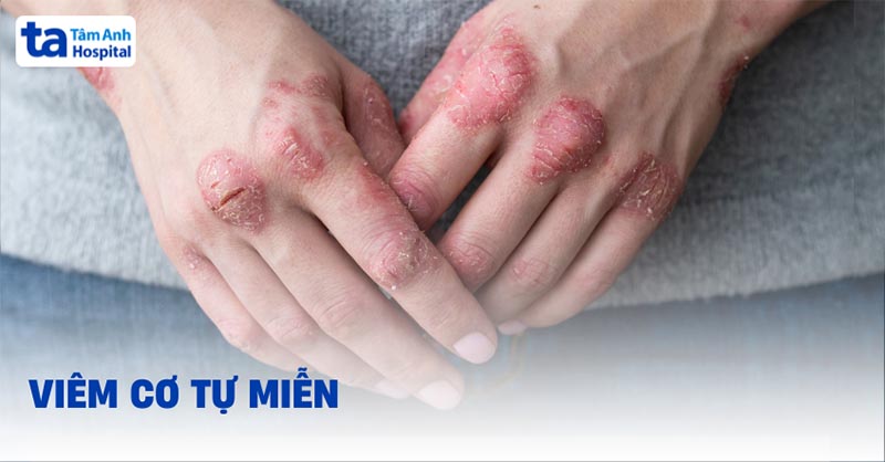 Bệnh viêm cơ tự miễn