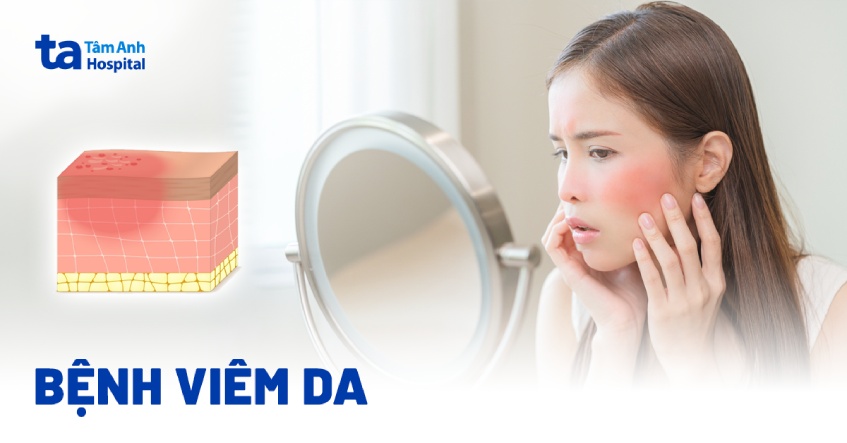 bệnh viêm da