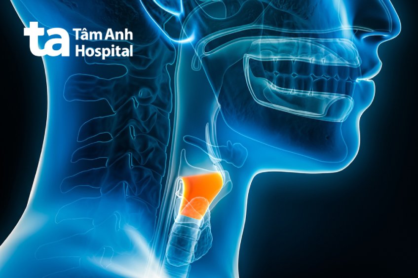 bệnh viêm thanh quản mãn tính