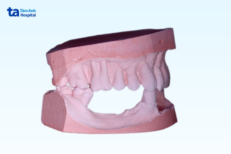 bien-chung-rang-bi-lung-lay