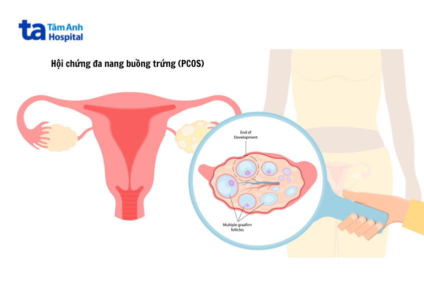 Buồng trứng đa nang có tự khỏi được không nếu điều trị tại nhà được mhiều chị em băn khoăn