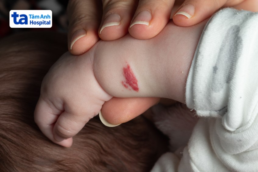 Bướu máu có thể xuất hiện ở bất kỳ vị trí nào trên cơ thể 