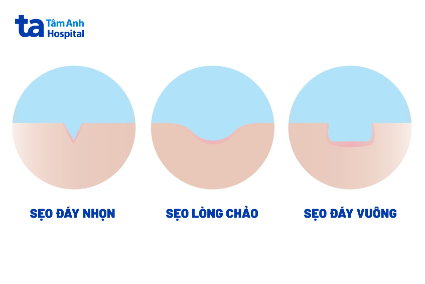 các loại sẹo thường lựa chọn chấm tca