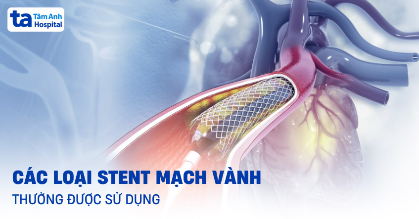 Các loại stent mạch vành: Ưu điểm, vai trò, khác biệt và lựa chọn