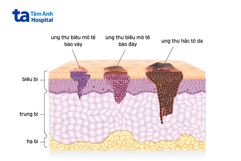 các tổn thương dưới da do ung thư