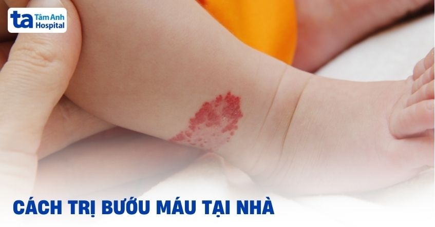 Cách trị bướu máu tại nhà cho trẻ em các cha mẹ nên biết