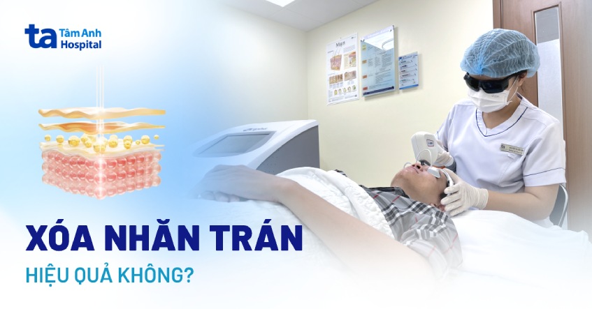 15 cách xóa nhăn trán giúp làm mờ hiệu quả an toàn ngay tại nhà
