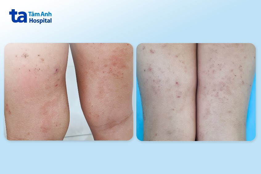 cáo gãi vì nhiễm ghẻ