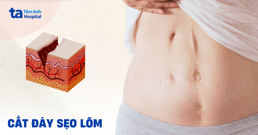 cắt đáy sẹo rỗ