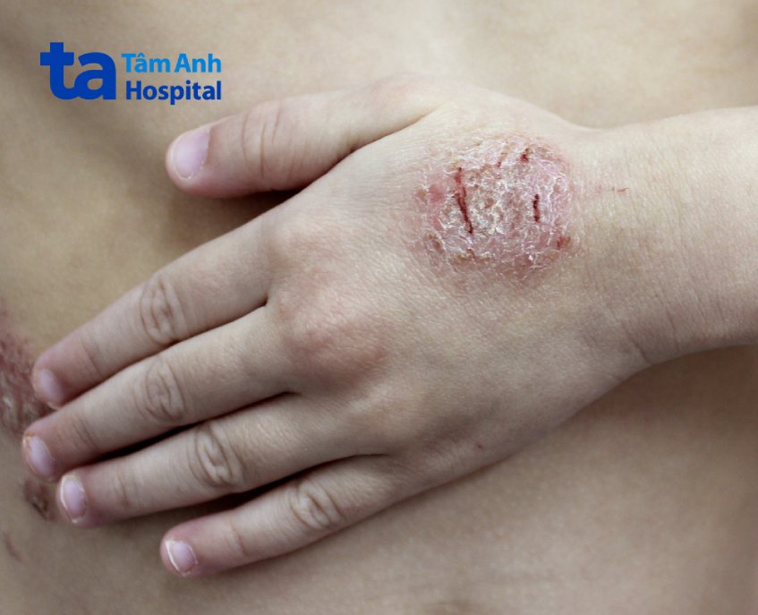 chàm đồng tiền