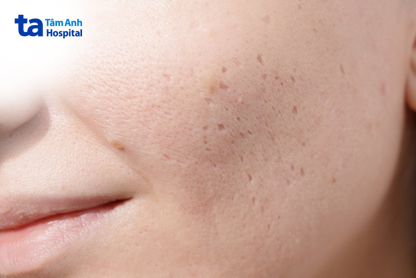 chấm tca thường được sử dụng rộng rãi với nồng độ khác nhau