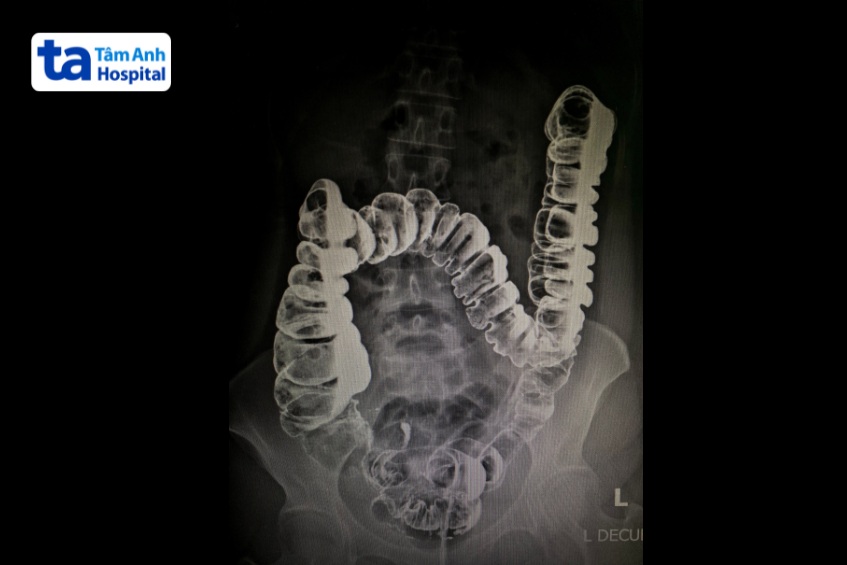 chẩn đoán viêm ruột cấp