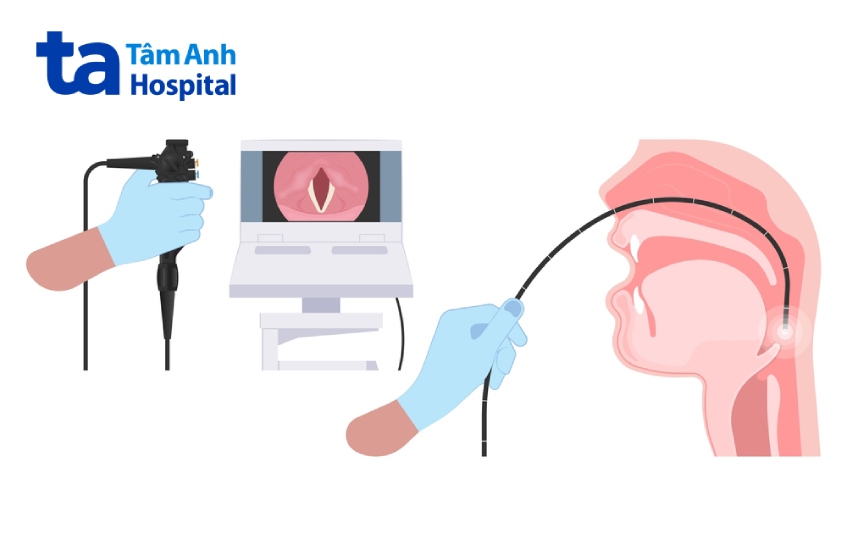 chẩn đoán viêm thanh quản mạn tính