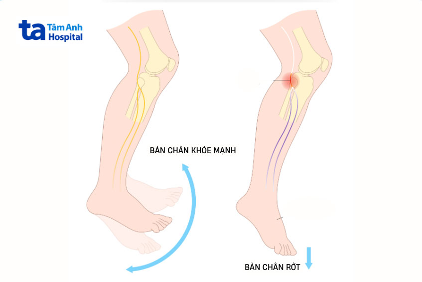 chấn thương hệ thống dây thần kinh