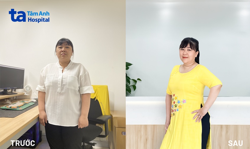 chị Thanh trước và sau giảm cân 10 tuần