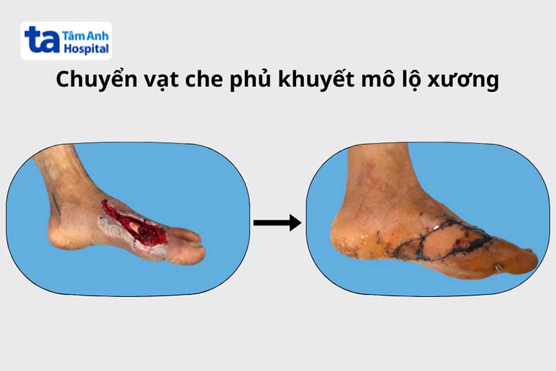 Phẫu thuật chuyển vạt da che phủ khuyết mô lộ xương sau chấn thương