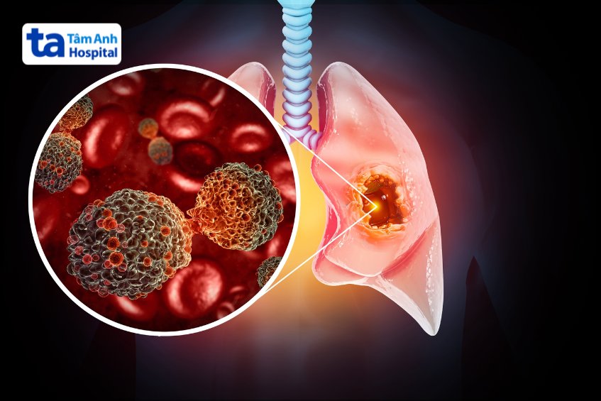 Có nhiều loại vi khuẩn có thể gây viêm phổi