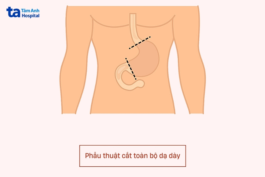 có thể sống sau khi đã cắt bỏ toàn bộ dạ dày