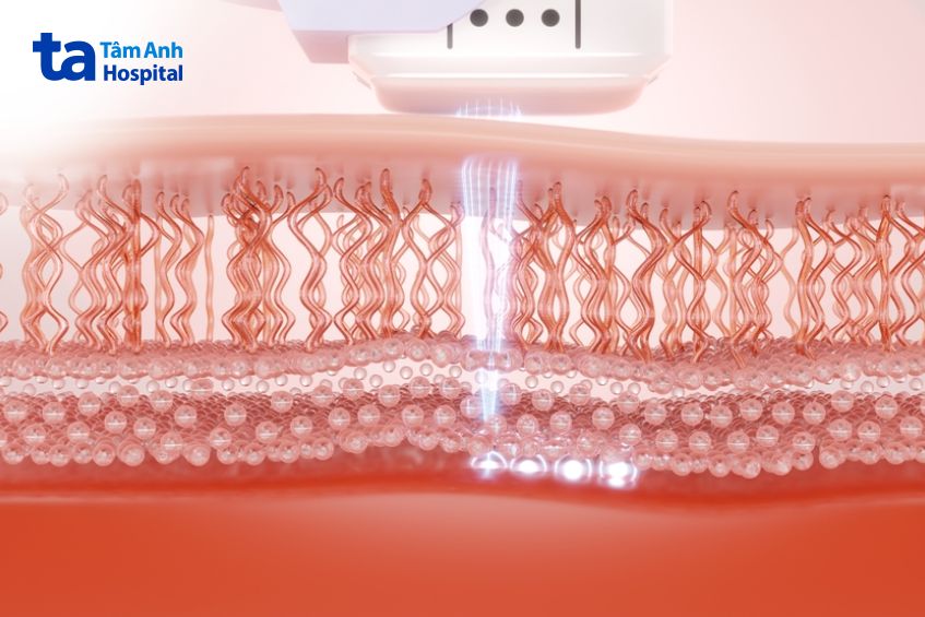 công nghệ superb xóa rãnh cười