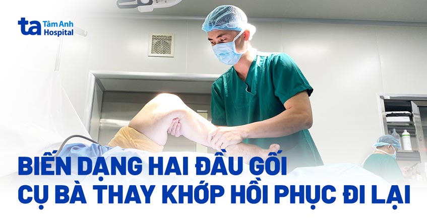Biến dạng hai đầu gối, cụ bà phải thay khớp để đi lại