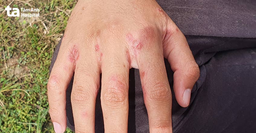 dấu hiệu của ghẻ nước