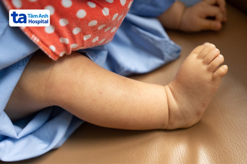 dấu hiệu giảm tiểu cầu trên da