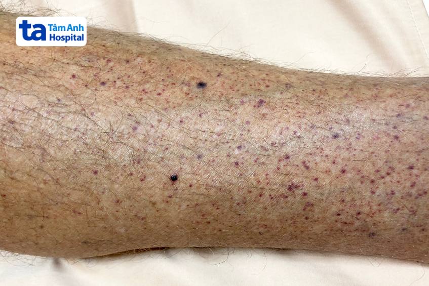 dấu hiệu xuất huyết giảm tiểu cầu