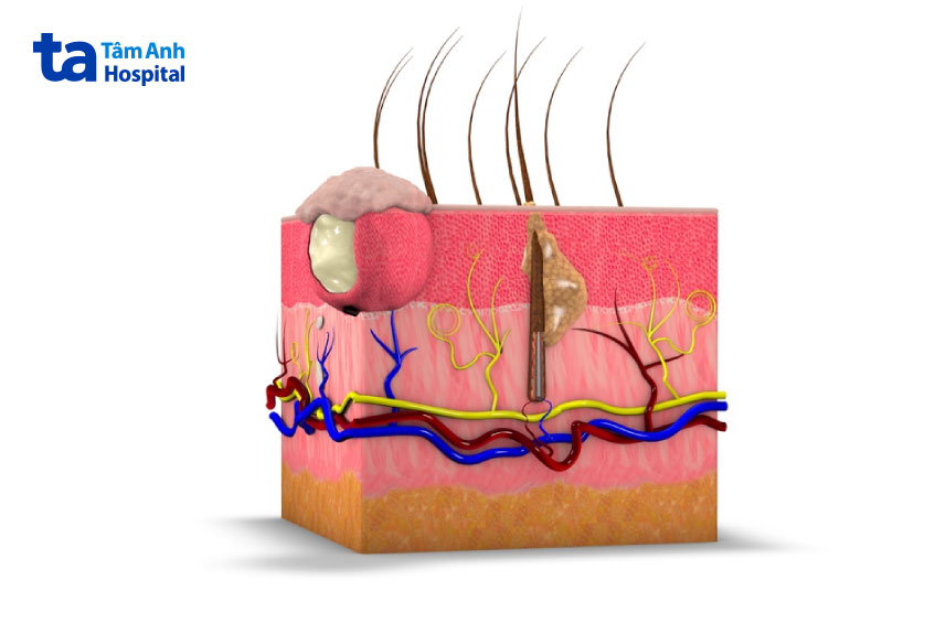 dễ gây biến chứng nếu không được điều trị