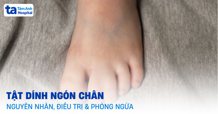 dị tật dính ngón chân