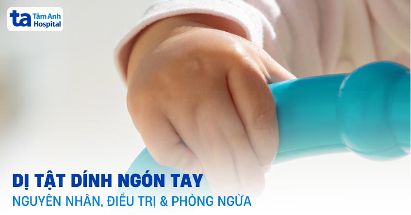 dị tật dính ngón tay