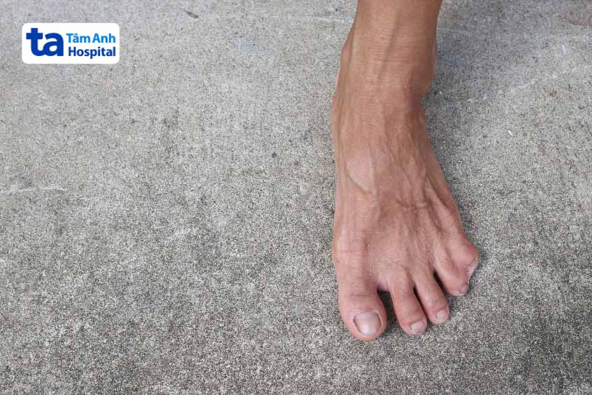 dị tật gây biến dạng ở bàn chân