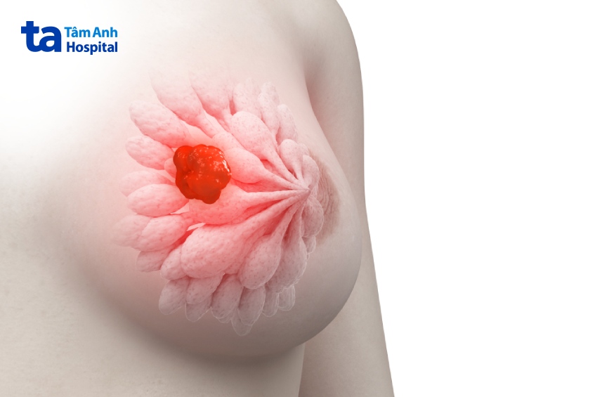điểm tái phát vú Oncotype DX