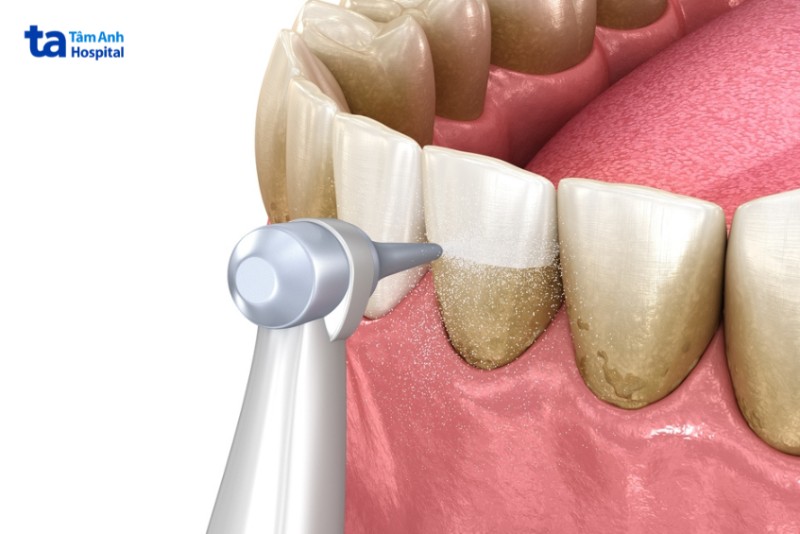 Điều trị răng lung lay bằng các điều trị viêm nướu, viêm nha chu
